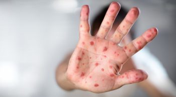 МОЗ: З початку року на кір захворіли більше 5 тис. людей